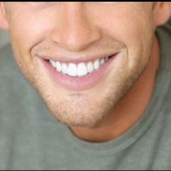 Picture of TEETH WHITENING TREATMENT - MEN ONLY